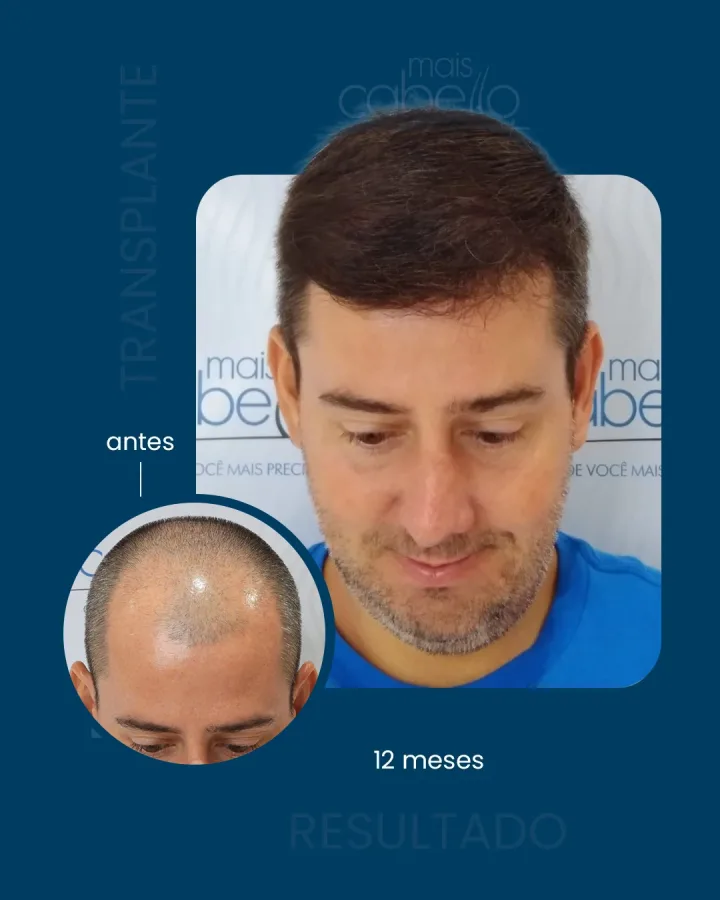Antes e depois Mais Cabello