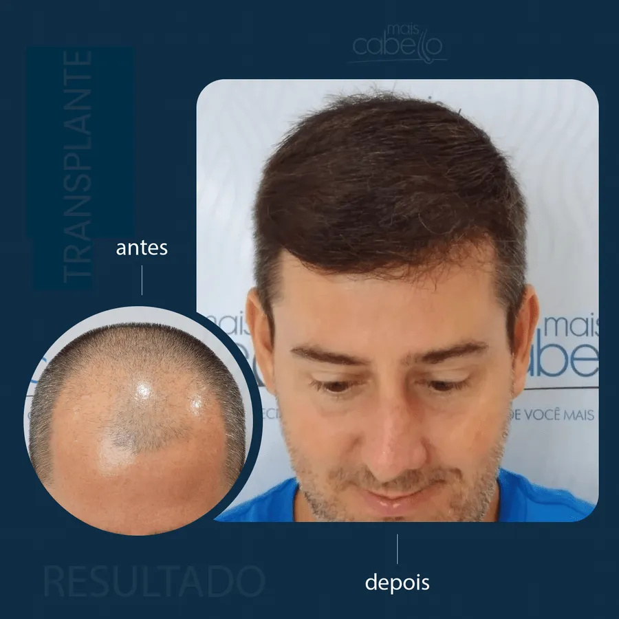 Antes e Depois - Transplante Capilar Masculino