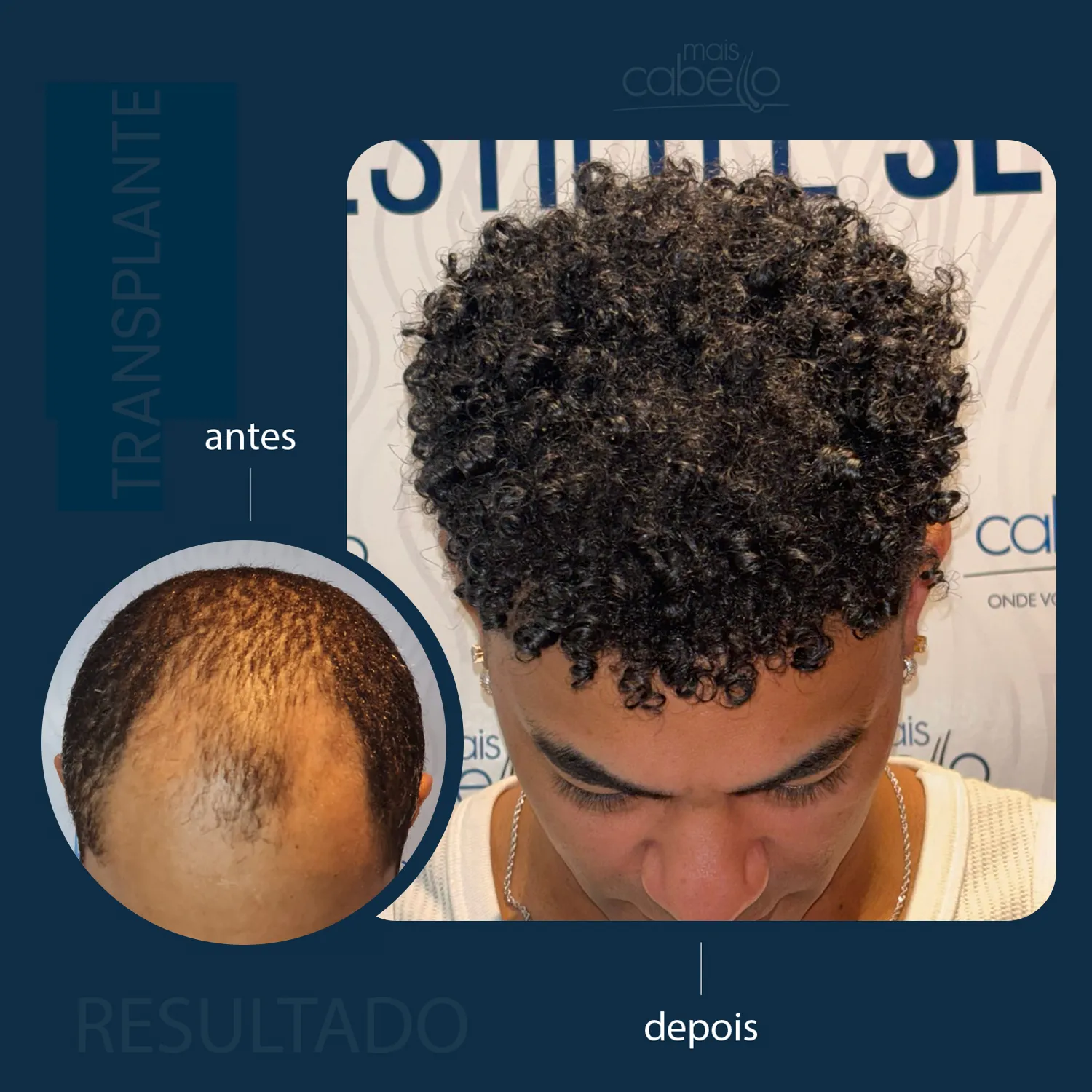 Antes e Depois - Transplante Capilar Masculino