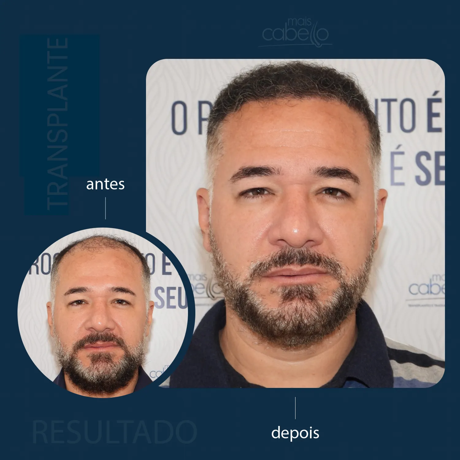 Antes e Depois - Transplante Capilar Masculino