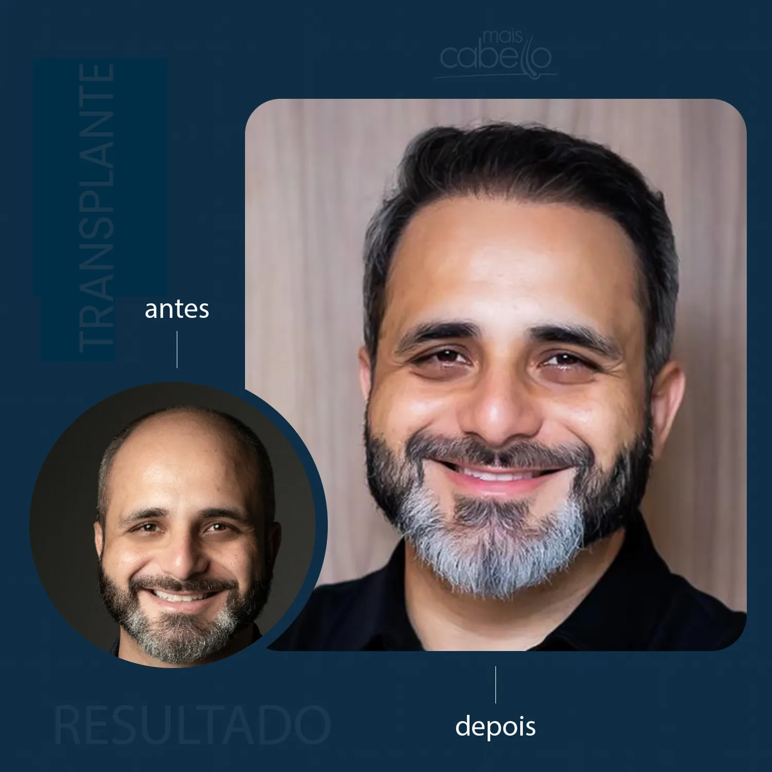 Antes e Depois - Transplante Capilar Masculino