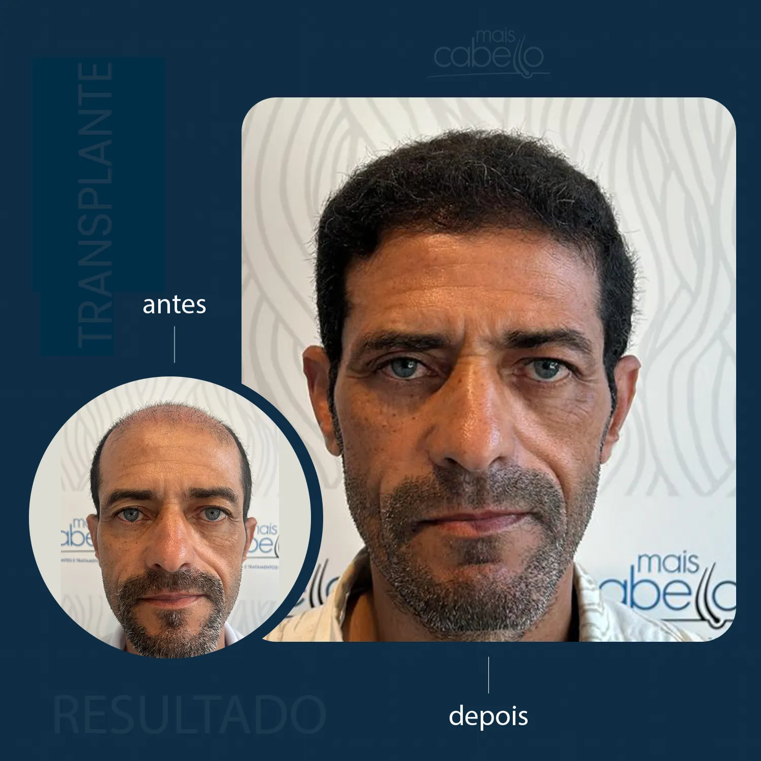 Antes e Depois - Transplante Capilar Masculino